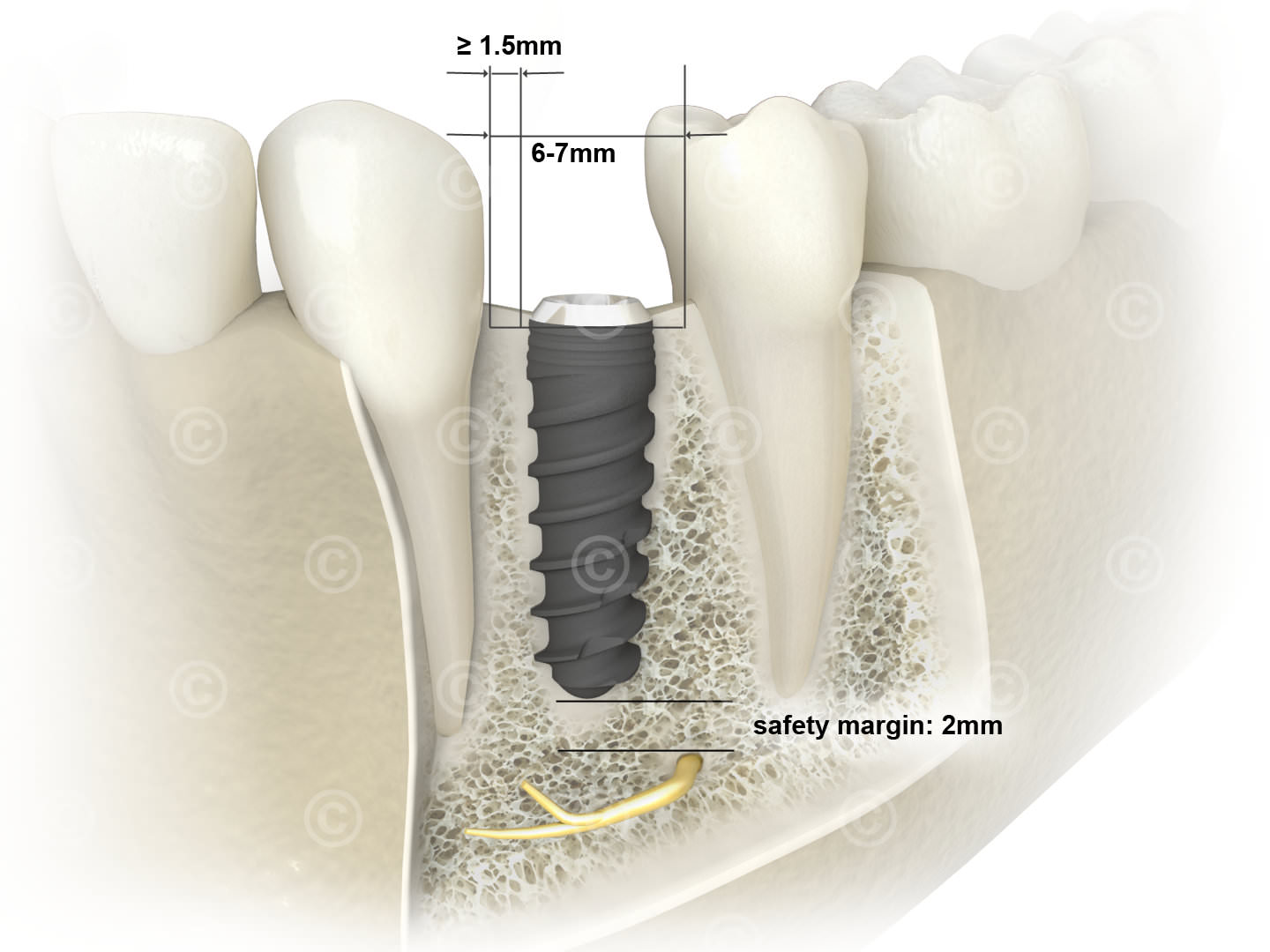 implantat sicherheitsabstaende unterkiefer